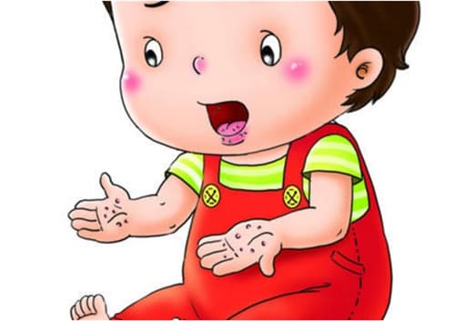 手足口病要注意些什么事项