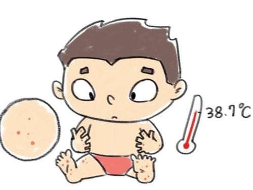 得了手足口病怎么护理
