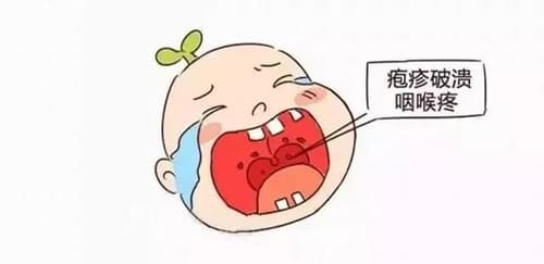 手足口病一定会发烧吗