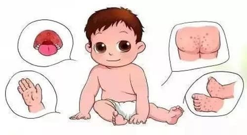 手足口病会复发吗