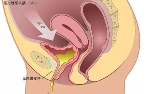 生产后多久可以做产后修复