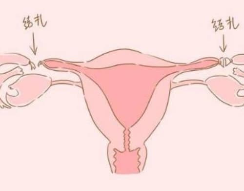 结扎和不结扎的女人有何区别