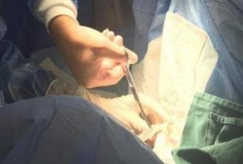 女人结扎了12年了还能接吗